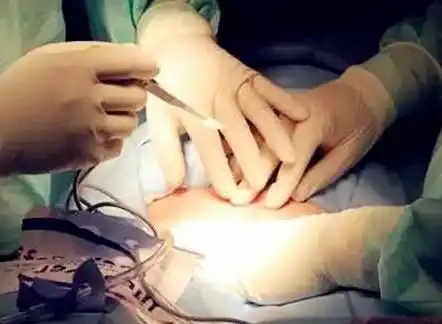 结扎对女人的危害度有多大?看完你就知道了!