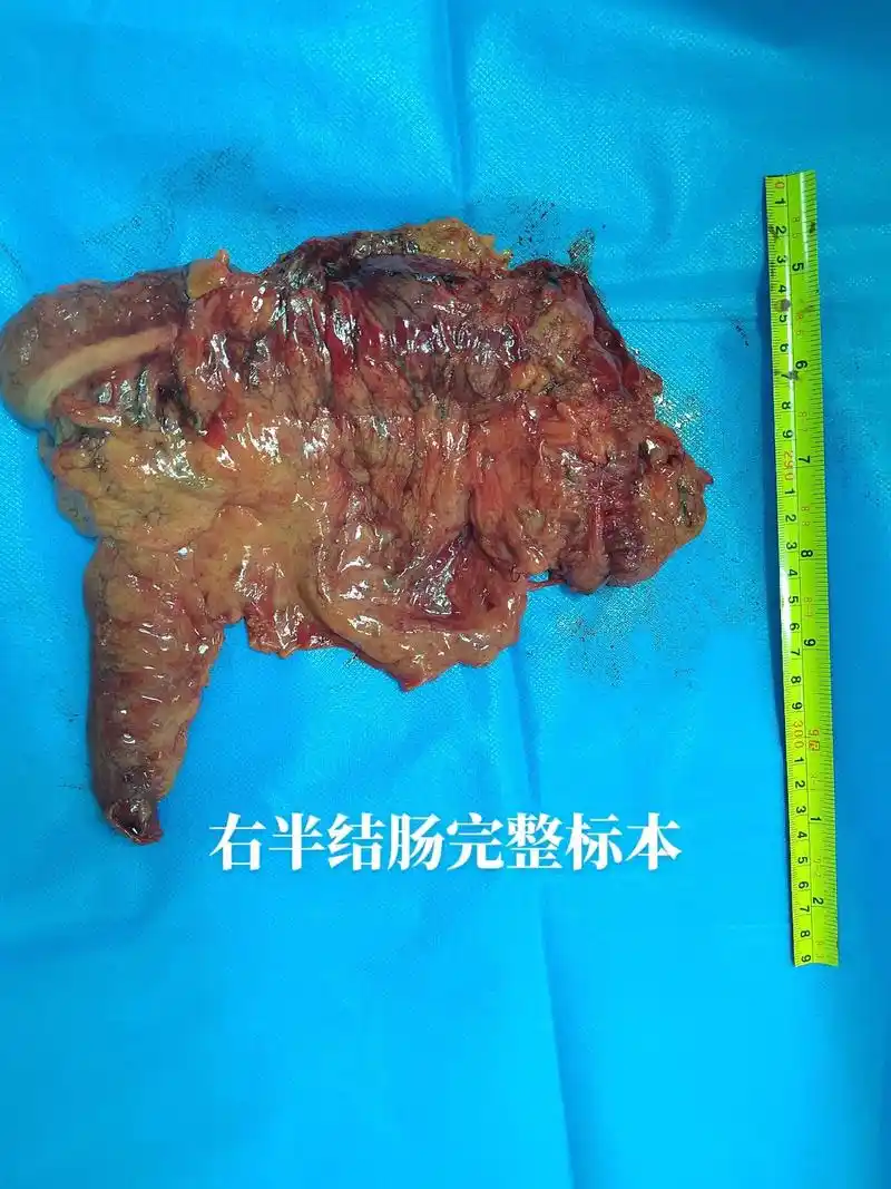 升结肠恶性肿瘤,术中探查黏连严重,肿物位置固定,穿透肠壁,浸 - 抖音