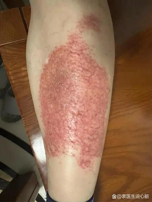 泛发性湿疹:今年春季人灾难,过敏经常莫名其妙就发生,保护皮肤黏膜的