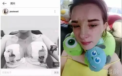 为了能火,她在19岁时选择假体隆胸!