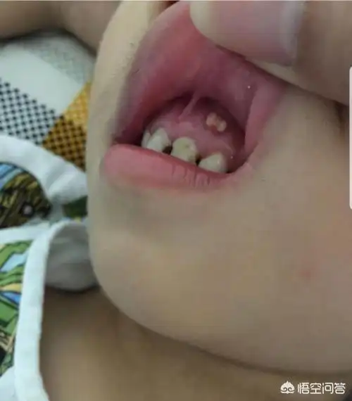 头条问答 - 乳牙牙龈上长了个包,该怎么办?(4个回答)