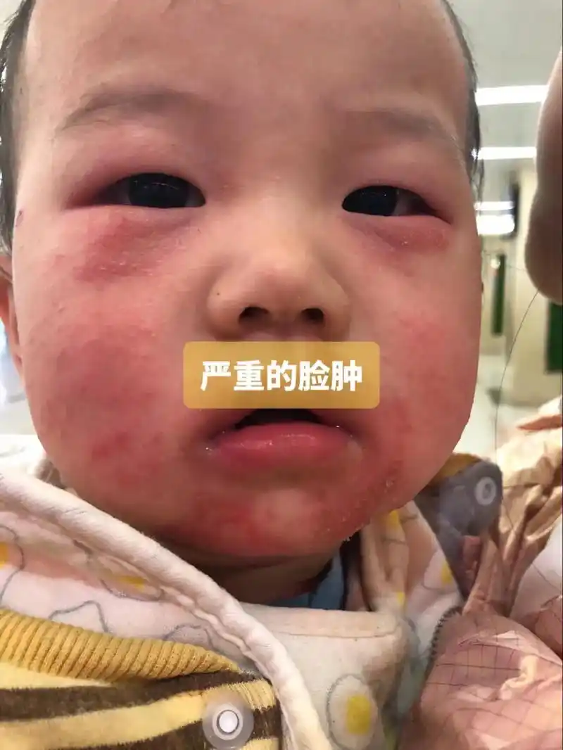 宝宝三个月后一直有几个顽固性湿疹在腿上,涂药膏一直 - 抖音