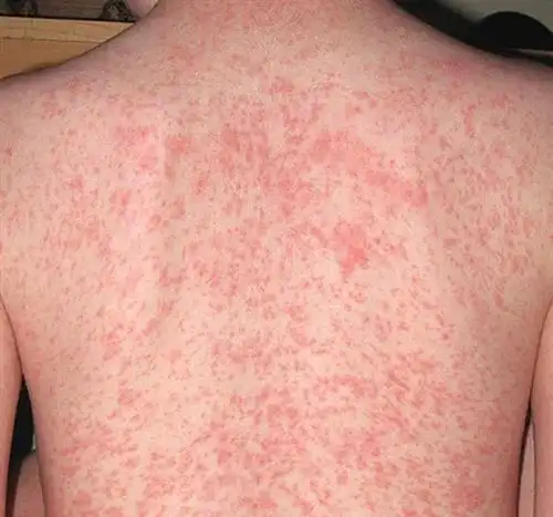 手上红疹是什么皮肤病