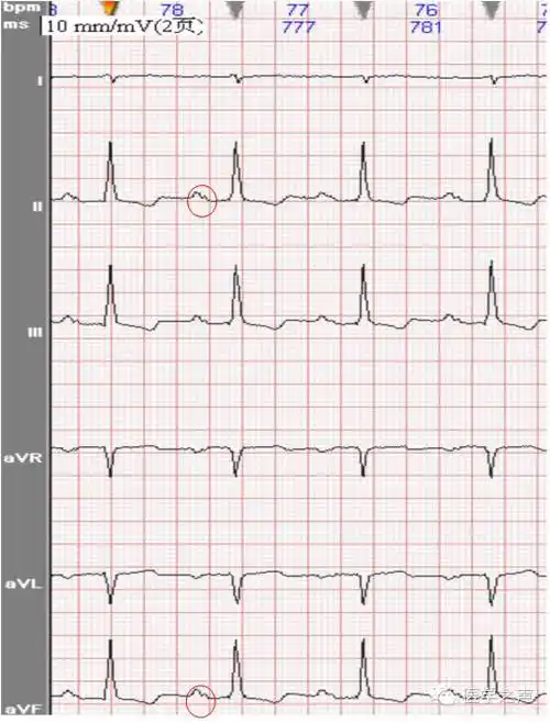 一,正常心电图p波正常窦性心律时,每个 qrs波前均有一个p波,p波在i,ii