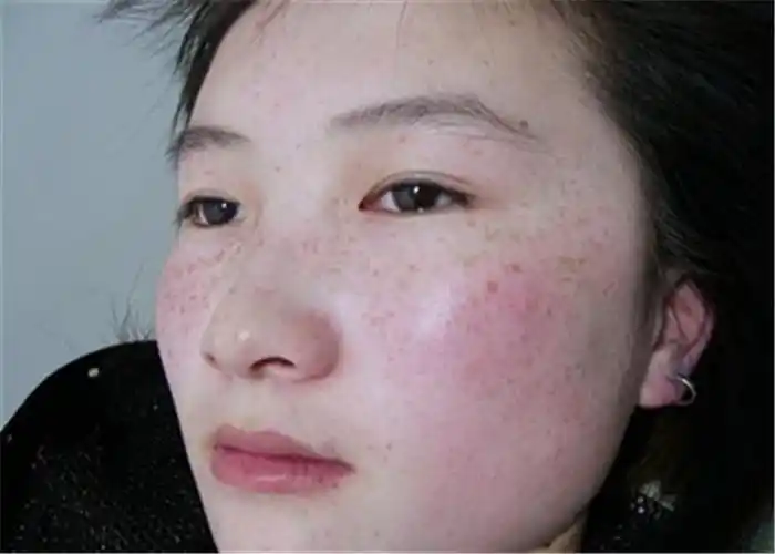 花斑癣大姐脸上的症状图片_有来医生