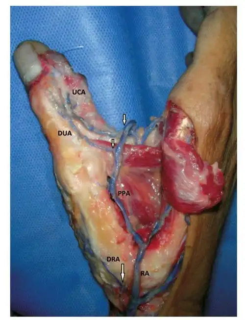远端穿向掌侧时,发出拇主要动脉(ppa,the princeps pollicis artery)