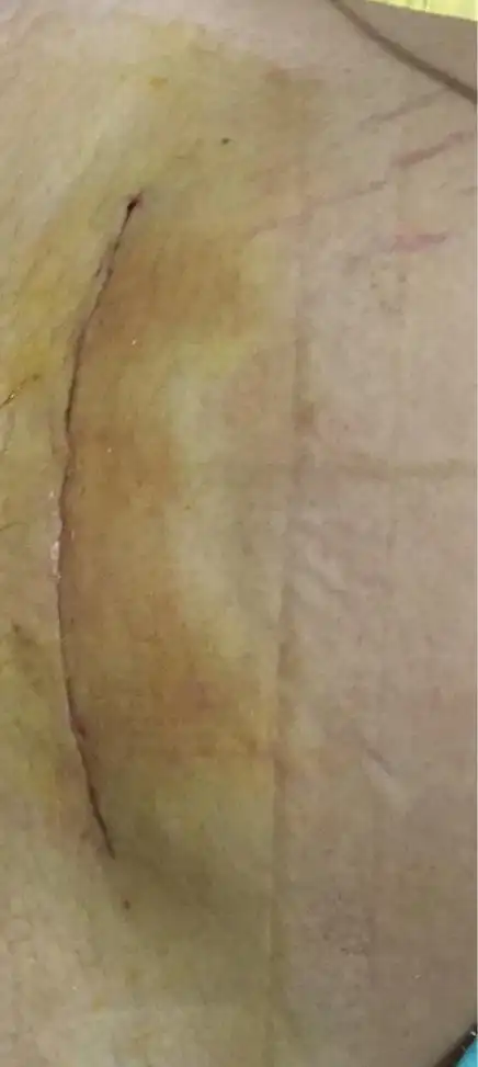 有没有剖宫产的宝妈,帮我看看我这刀口长得怎么样,有点吓人,介意者