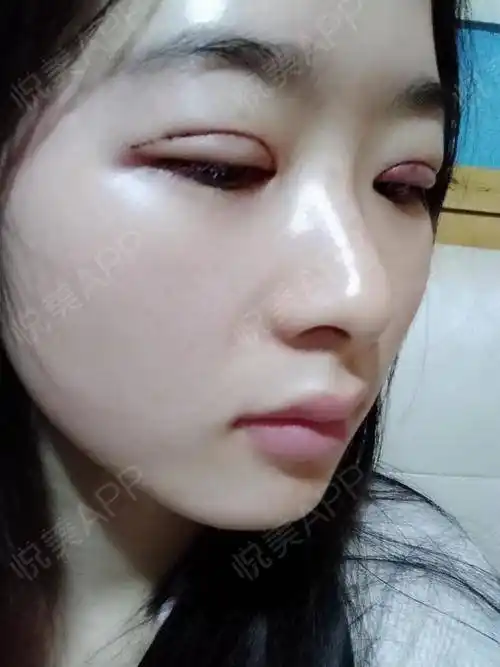 成败就在此一举了,美不美就在此一举了,刚做完手术1.