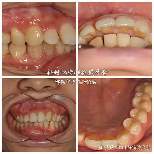 邯郸市牙病防治所隐适美隐形矫正初戴外院矫正失败二次矫正