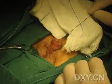 【资料】一例尿道下裂手术经过(多图)