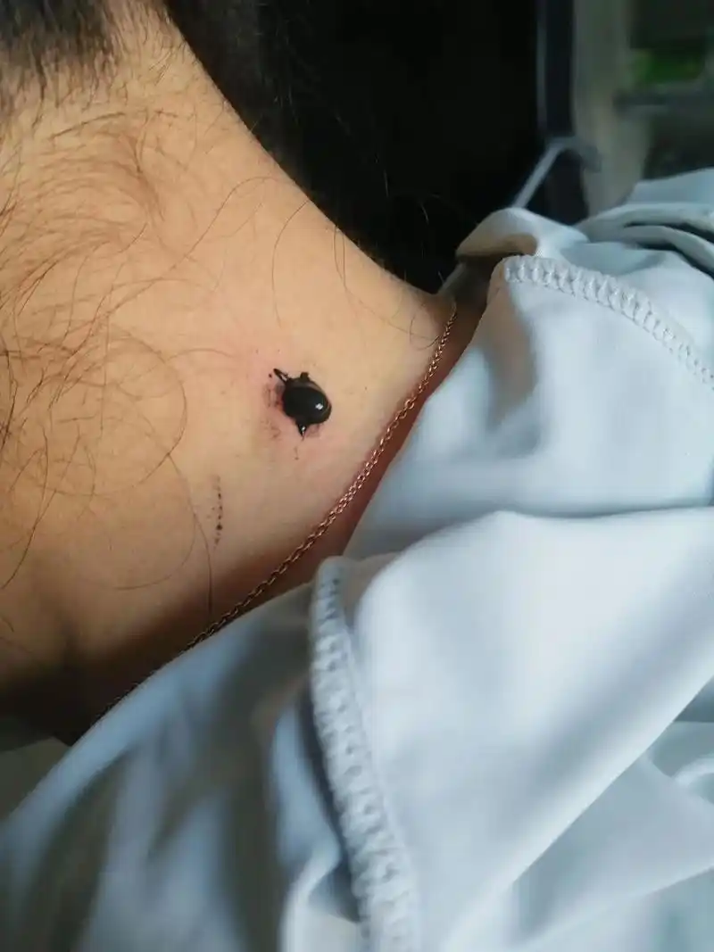 皮肤赘生物中药无痛无疤祛除 - 抖音