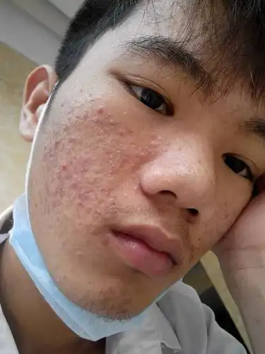 我脸上长了好多痘痘.怎么办好?