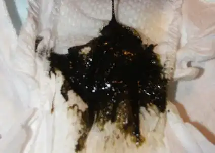 stuhlgang bei babys - in bildern erkl01rt