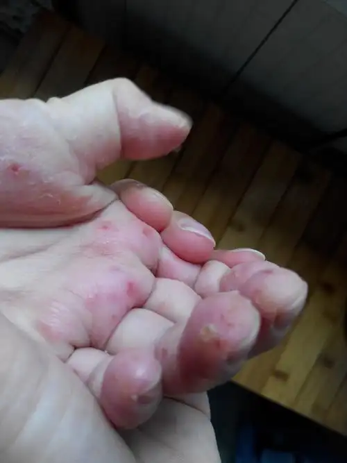 孩子6岁,从小就有汗疱疹的毛病,只是今年太严重了,一直用北京儿研所开