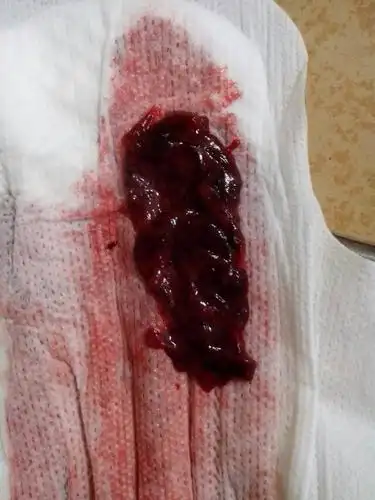 今天来月经肚子痛,量也比较多.