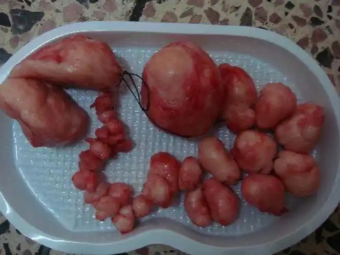 多个子宫肌瘤手术切除图片