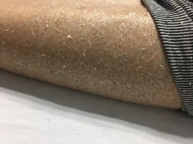 皮肤特干鱼鳞皮有什么办法吗?