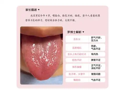 图解儿童舌诊40:肝气不舒的孩子也会伤阴