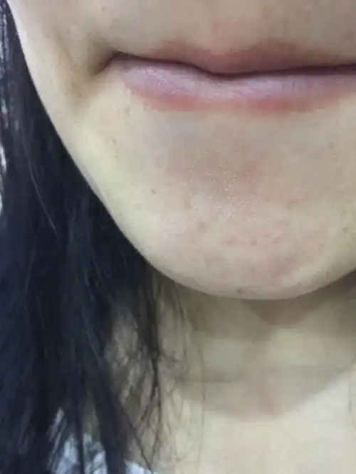 下巴下面有好多这样的类似黑头的白点点.这个是叫什么,怎么去除啊?