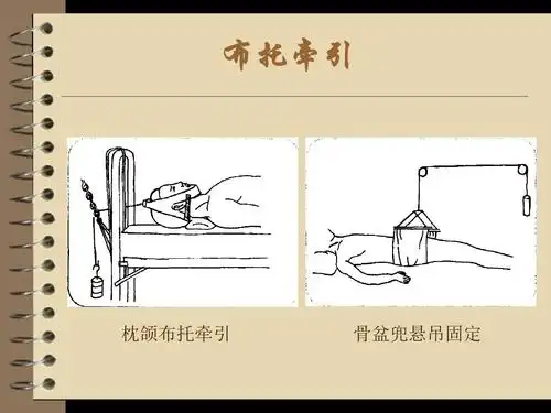 布托牵引 枕颌布托牵引 骨盆兜悬吊固定