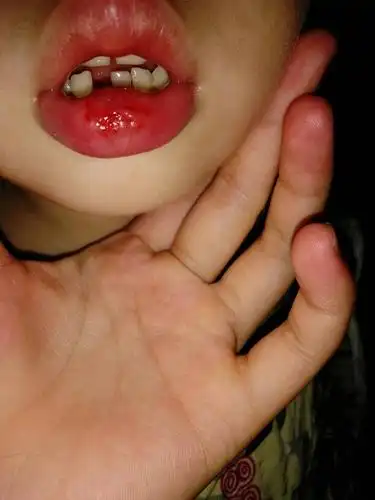 刚才小孩在厕所摔了一跤,嘴巴破了点皮,流血不多,好像肿了,怎么处理