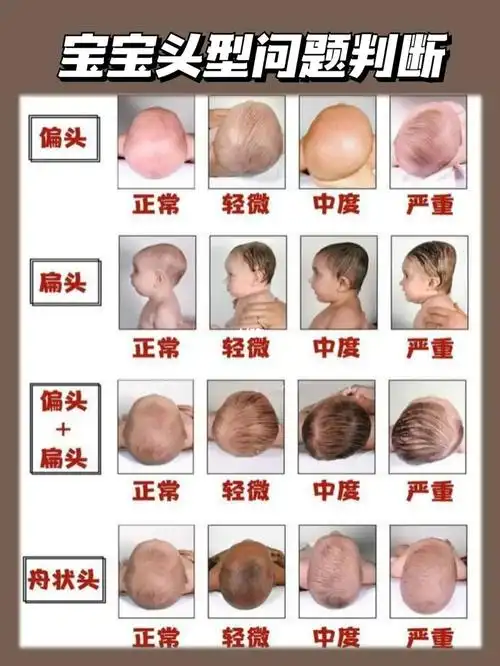 如何睡处好头型72舟状头逆袭小圆头干货贴95_头型_吐奶_红薯_黄金