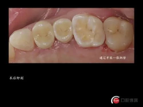 两颗双尖牙的死与生