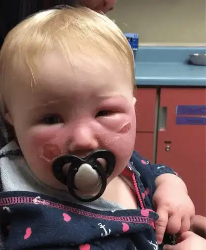 14个月女儿「脸上突然长出水泡」又红又肿,母亲哭诉:为什麼「这个产品