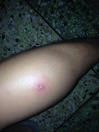 问:腿上长了几个疙瘩,中间有点化脓,很痛