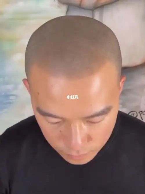 男士全头纹发即可效果_秃头_生发_望海国际广场自由行热门攻略_代谢