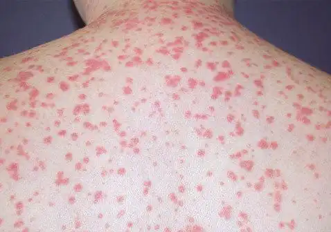 小的,点状的红色斑块:手臂腿头皮躯体点滴状银屑病是第二常见的牛皮癣