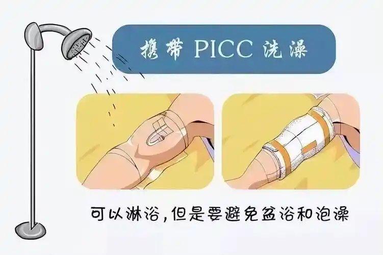 picc健康指导经外周静脉置入中心静脉导管(peripherally inserted