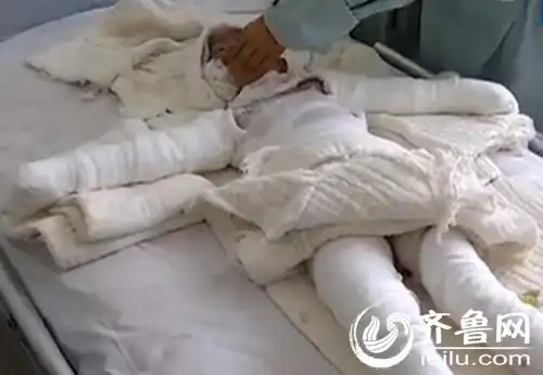 李艾宁的全身裹满纱布(视频截图)