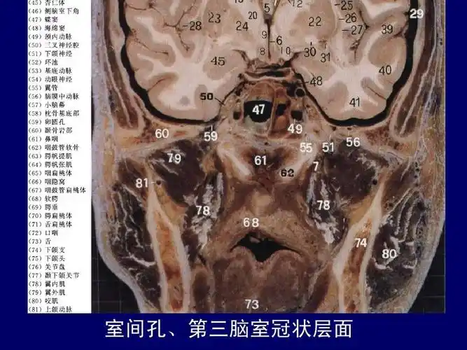 上海交大医学院断层解剖学,考试复习必备! 室间孔,第三脑室冠状层面