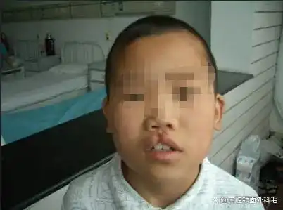 这是一种口腔颌面部的先天性畸形,发现宝宝患有唇腭裂该怪谁需要先
