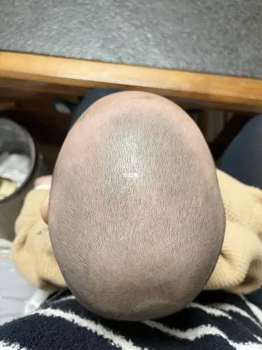 1岁三个月舟状头还能矫正吗?_长头发_母婴_育儿经验