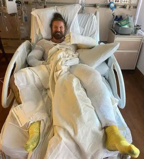 美国歌手遇篝火事故!致全身烧伤25%,晒病床照身上缠满白色绷带