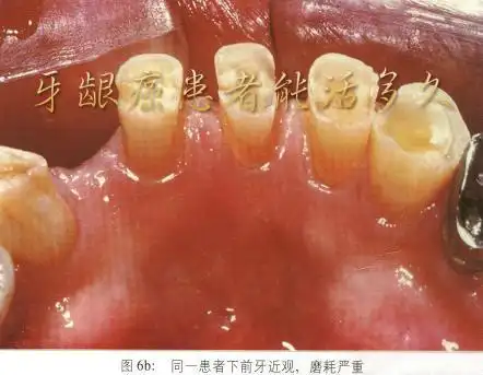 牙龈癌患者能活多久