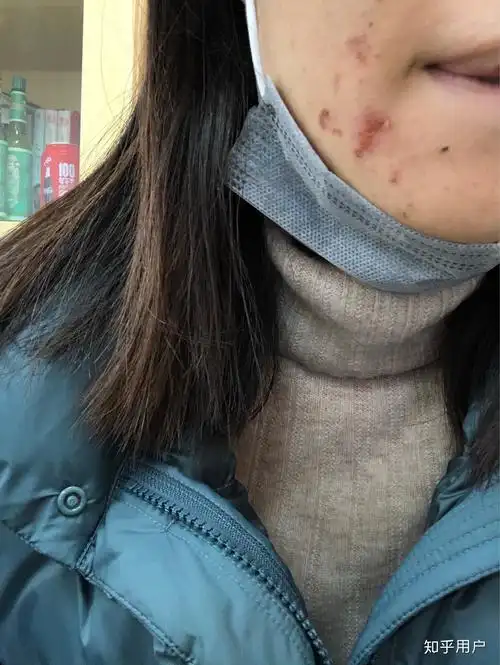 呜呜呜呜有没有做过果酸换肤的姐妹第一次做完果酸换肤第二天就结痂