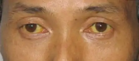 为什么有的胰腺癌出现黄疸,有的却没有?