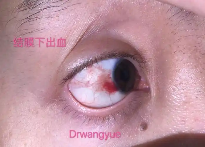 白眼球突然出血,要不要去眼科就诊?