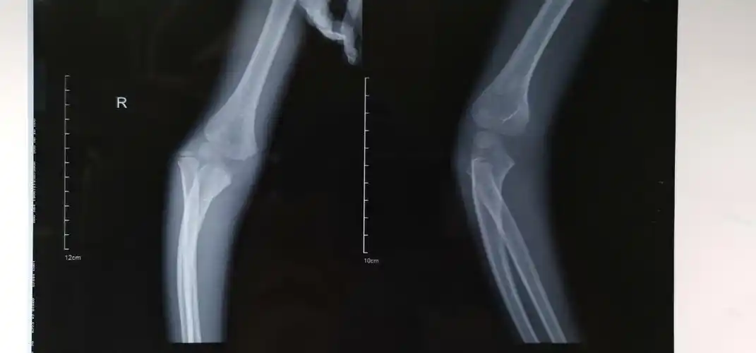 尺骨鹰嘴骨折伴桡骨小头脱位