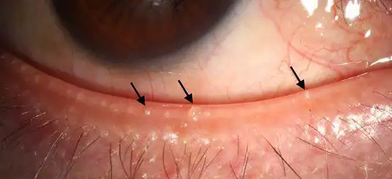 常德的干眼症患者常德首台干眼治疗黑科技落户常德爱尔眼科医院
