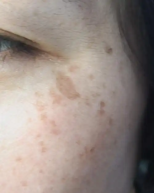 二,在皮肤损伤早期,使用减轻色素药物,如喜辽妥膏,氢醌霜,氨甲环酸