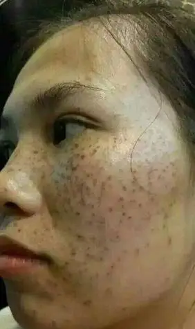 女人面相学面部黑斑 脸上黑斑面相