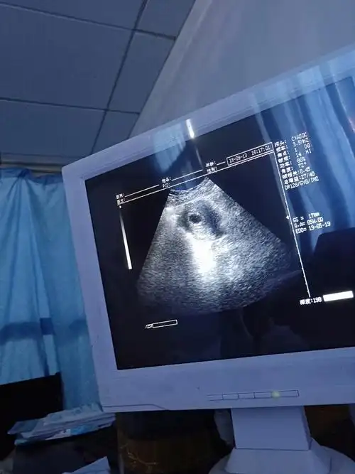 温和!孕囊大小"高朋满座"-第1张图片-佩珍博客