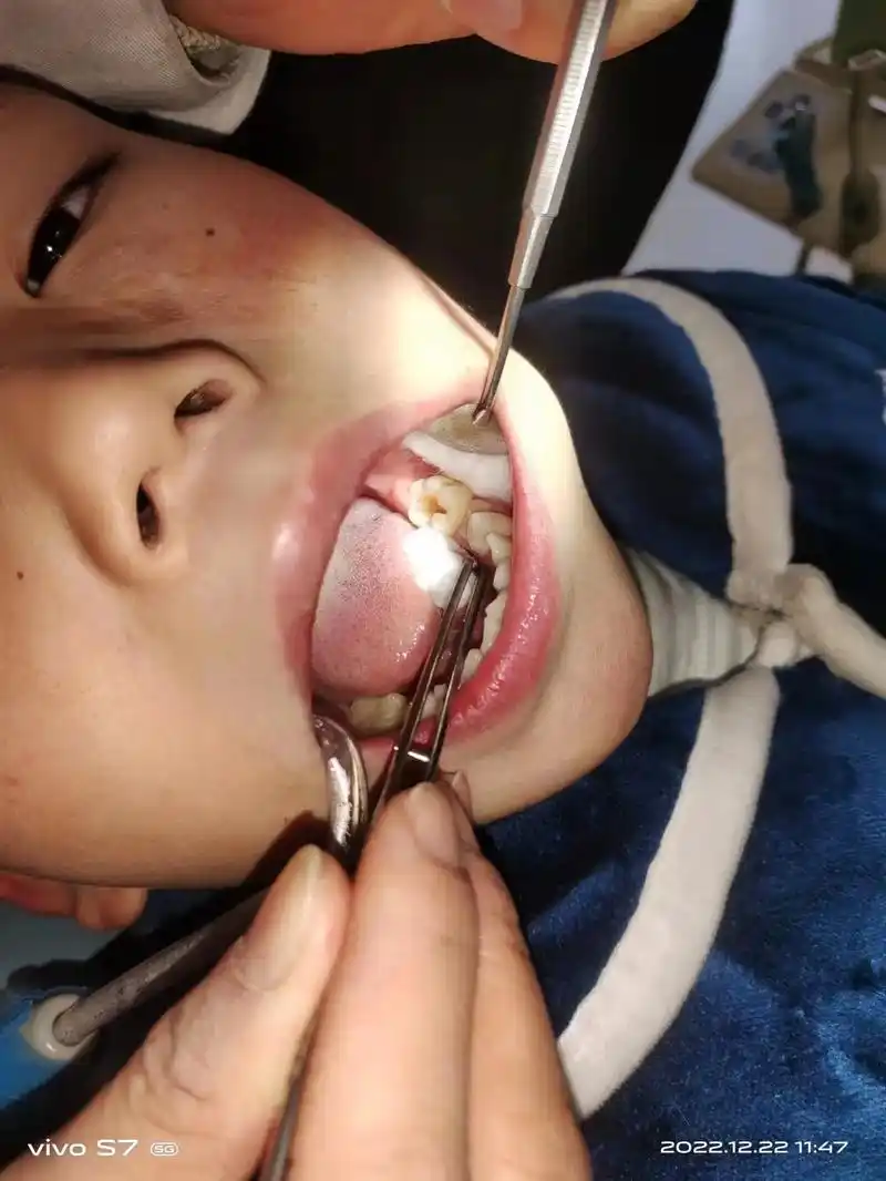 图一,图二是补牙前的图片,图三,图四是补牙后的图片.小朋友有 - 抖音