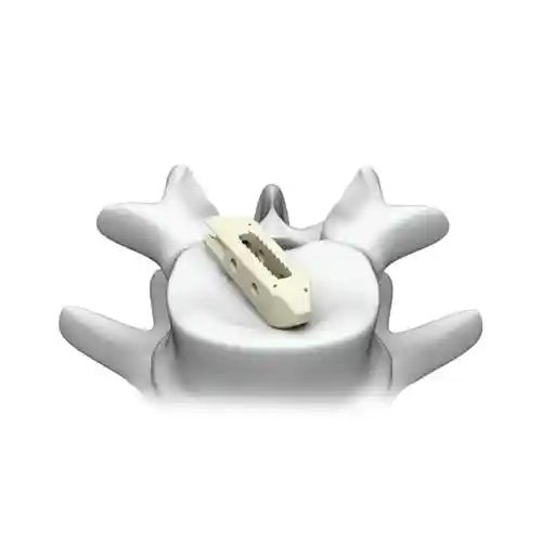 腰椎间融合器plateau03lo