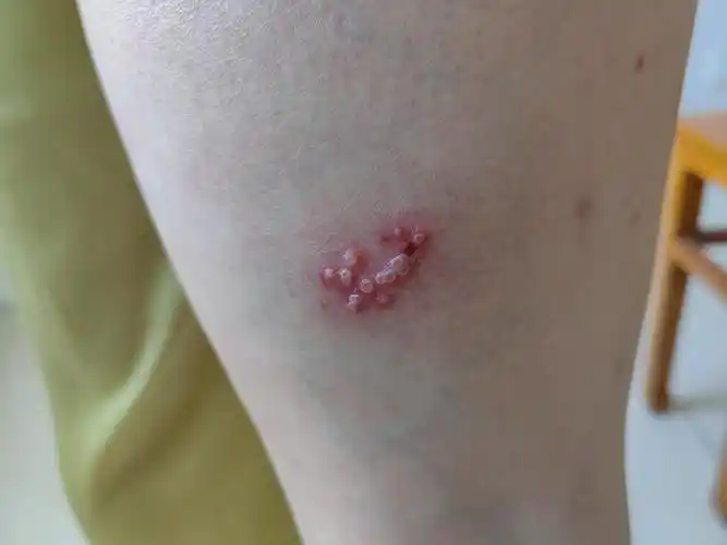 单纯疱疹和带状疱疹怎么区别?-朱敏刚主任医师-爱问医生