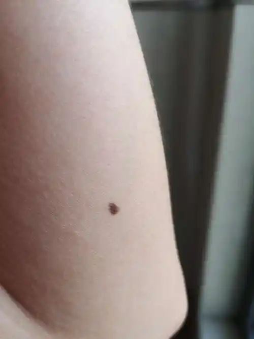 董医生我来问一下胳膊内侧上有颗黑痣从小就有也不记得它